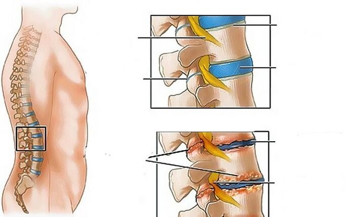 Nimmepiirkonna osteokondroos