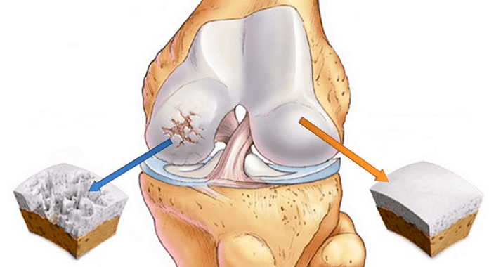 terved ja artroosist kahjustatud kõhred
