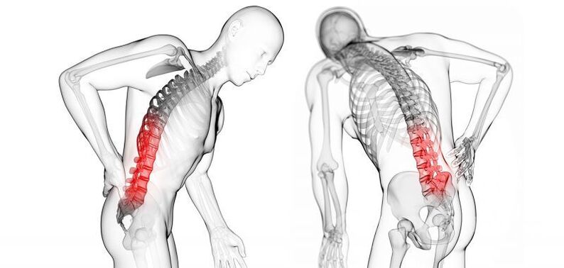 tüsistused emakakaela osteokondroosiga